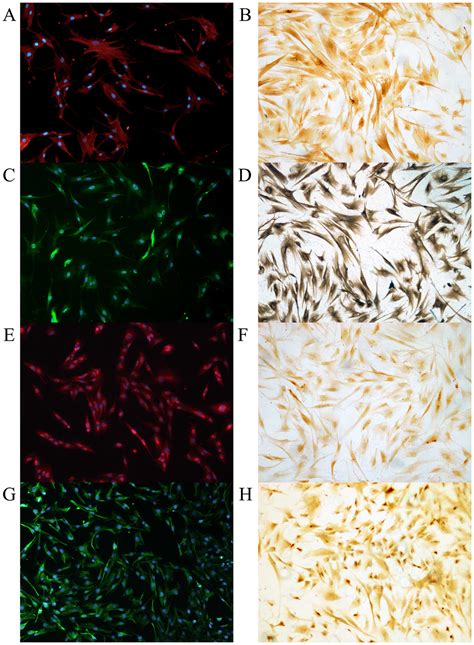 Activation Of Pancreatic Stellate Cells Involves An Emt Like Process