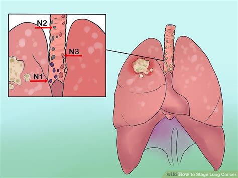 Mucus Filling Up Lungs