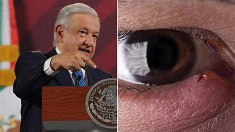 Qué es un Tutupiche el padecimiento ocular que AMLO mencionó tener