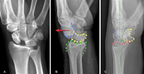 lunate dislocation xray - ALiEM