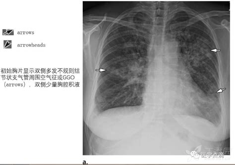 病毒性肺炎影像学特征 影像核医学 丁香园论坛