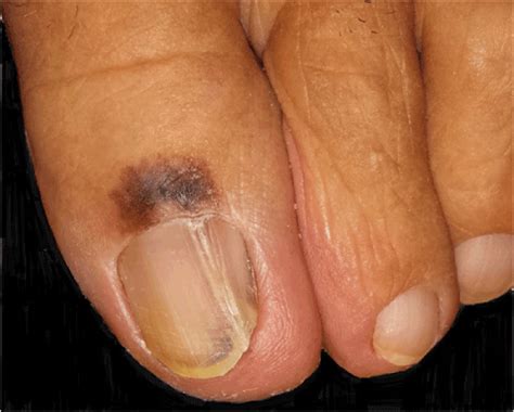 Melanoma Under Nail Bed Photos Nail Ftempo