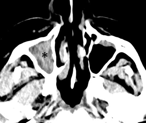 The Preoperative Sinus Ct Avoiding A “close” Call With Surgical