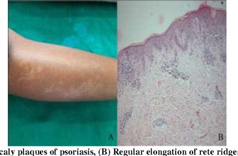 Figure 2 From Study Of Clinico Histopathological Correlation Of