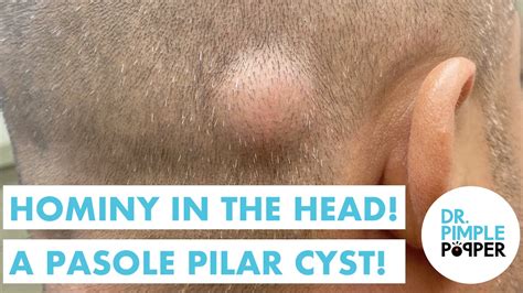 Hominy In The Head A Pasole Pilar Cyst Recently Added Dr Pimple