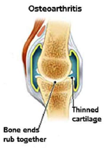 Msk Pathology Diseases Of The Joints Flashcards Quizlet