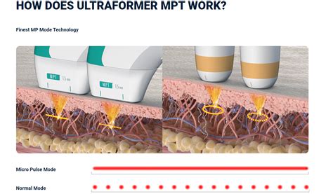 Especialista Na Aplica O Do Ultraformer Mpt Injectors Club