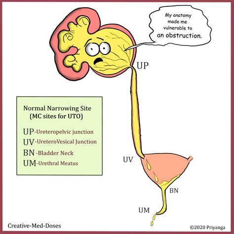 Ureterovesical Junction Obstruction