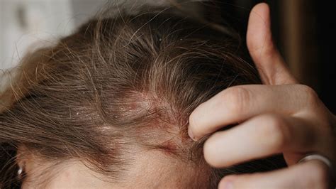 Scalp Psoriasis Symptoms Causes And Treatment