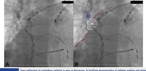 Acute Procedural Complications Of Cryoballoon Ablation A Comprehensive Review Semantic Scholar