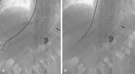 Hepatic Splenic And Portal Vascular Systems Radiology Key