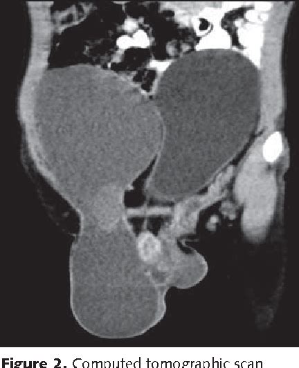 Figure 2 From Lower Abdominal Swelling And Scrotal Enlargement Semantic Scholar