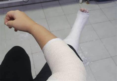 ТЕТОВЧАНКА СКРШИ НОГА И ПОВРЕДИ РАКА БЕГАЈЌИ ОД КУЧИЊА СКИТНИЦИ - Сакам ...