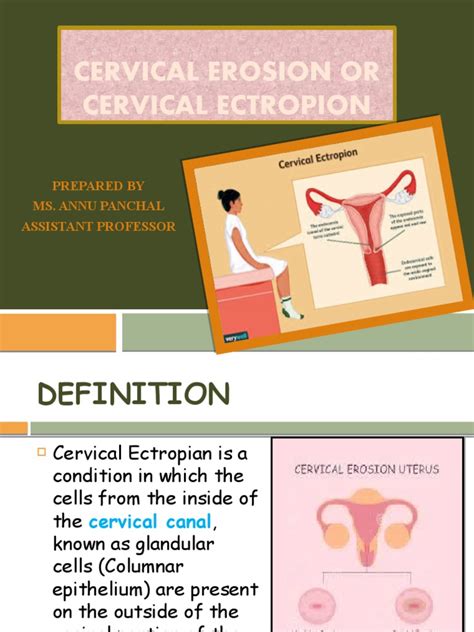 Cervical Erosion Or Cervical Ectropion Prepared By Ms Annu Panchal