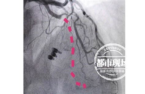 50歲男子突發心梗 就因為吃了這樣東西 有心血管疾病的要注意了 每日頭條