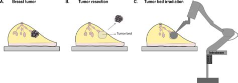 Targeted Intraoperative Radiation Therapy During Breast Conserving