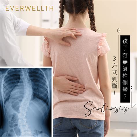 發育中孩子容易有「脊柱側彎」！了解判斷及預防措施 Medical 2022 05 30 Everwellth