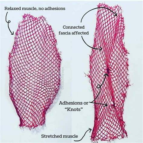 What Is Fascia Mount Lawley Physiotherapy