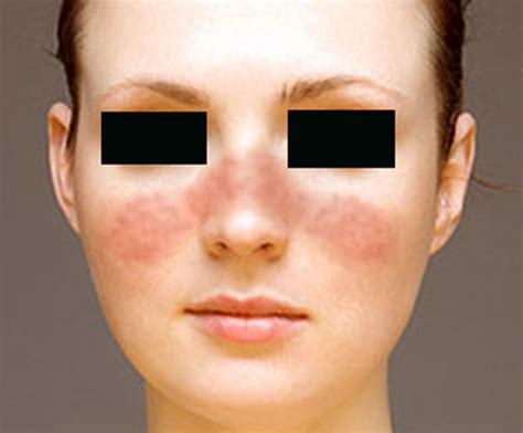 Systemic Lupus Erythematosus Pictures Symptoms Causes Treatment