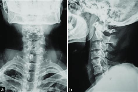 The Preoperative Anteroposterior A And Lateral B Radiograph Showing