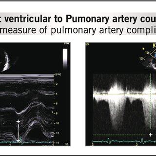 Right Ventricular To Pulmonary Artery Coupling As A Measure Of