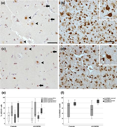 Expression Of P16 And P21 In The Frontal Association Cortex Of ALS MND