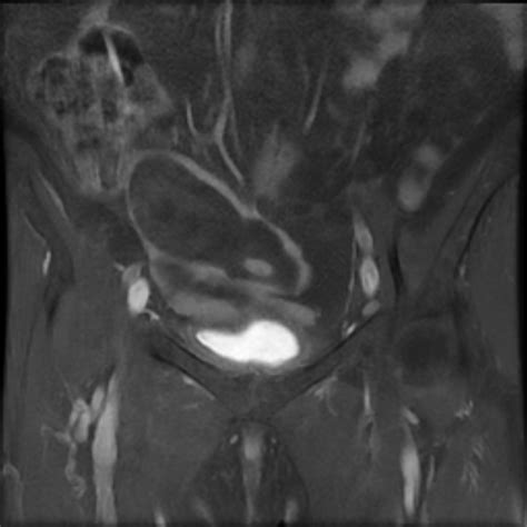 Appendicular Mucocele With Pseudomyxoma Peritonei Image