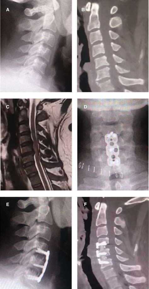 Frontiers Osteophyte Formation Causes Neurological Symptoms After Anterior Cervical Discectomy