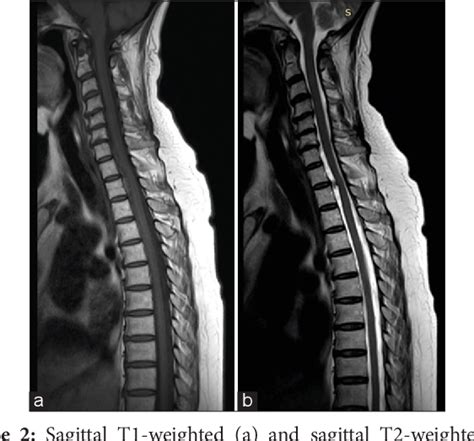 Figure From Spontaneous Anterior Cervicothoracic Spinal Epidural