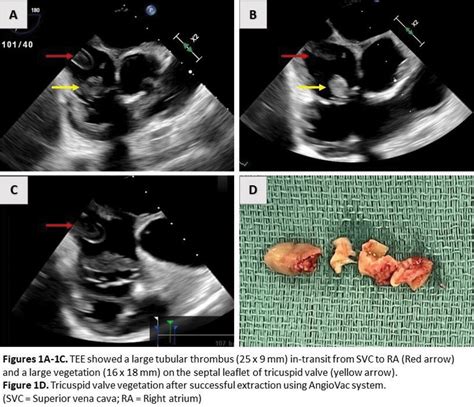 Concomitant Tricuspid Valve Vegetation And Catheter Related Atrial