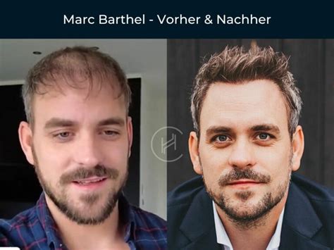 Promis Mit Haartransplantation Vorher Nachher Vorher Nachher