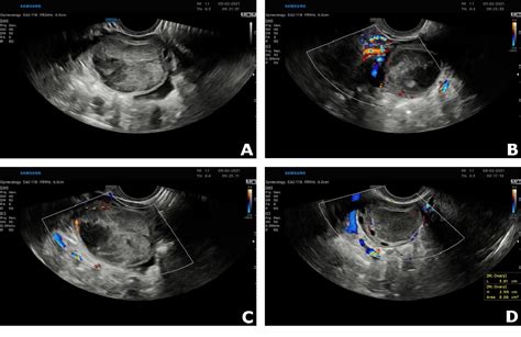 Figure 1 From Ultrasonographic Signs Of Acute Ovarian Torsion