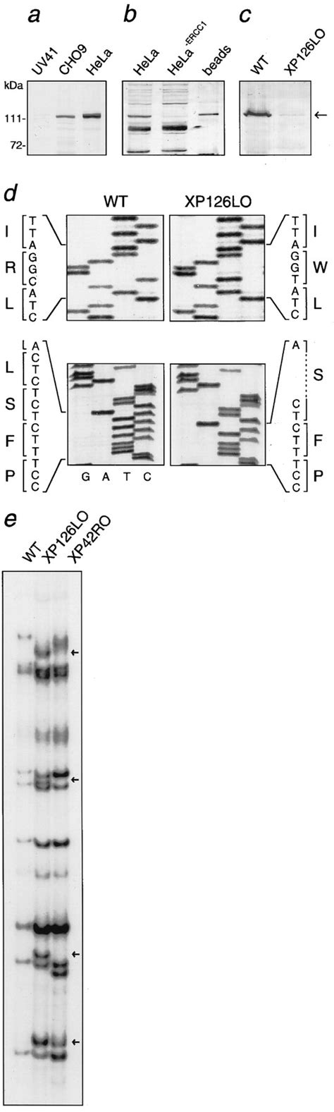 Xeroderma Pigmentosum Group F Caused By A Defect In A Structure