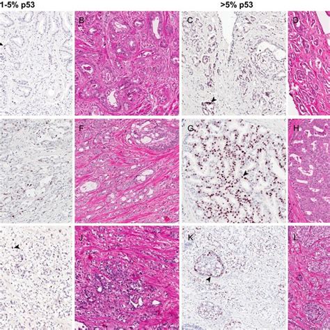 Representative P Expression In Index Tumors Clustered By Tumor Grade