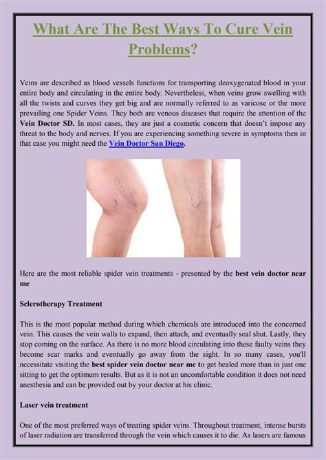 What Are The Alternatives For Spider Vein Therapy By Harold Mehta Issuu