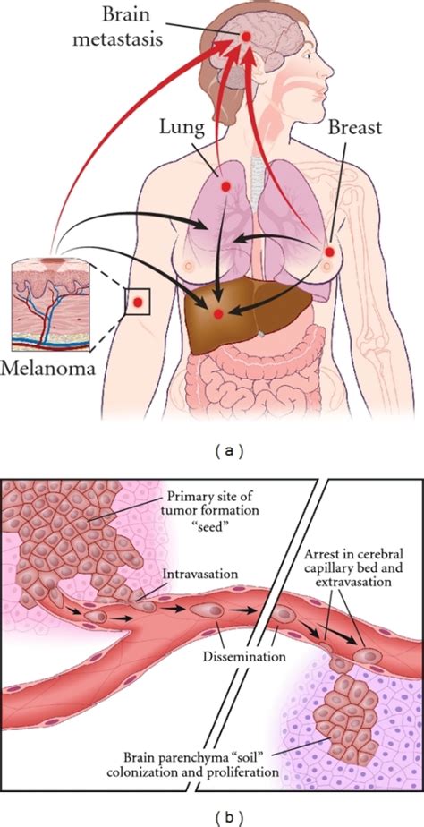 Schematics of the process of metastasis. (a) Formation | Open-i