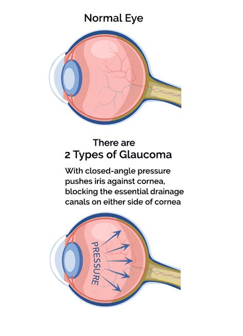 Glaucoma Eye Exam In Sanford Advanced Eyecare