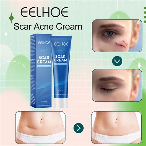 Jual Eelhoe Keloid Removal Salep Obat Penghilang Keloid Bekas Luka