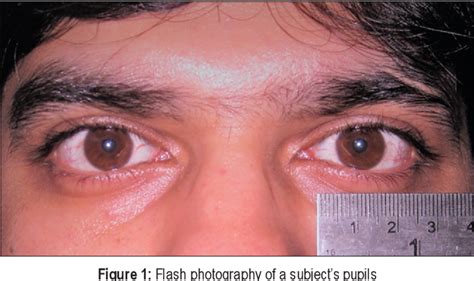 Figure 1 From The Prevalence Of Physiological Anisocoria And Its