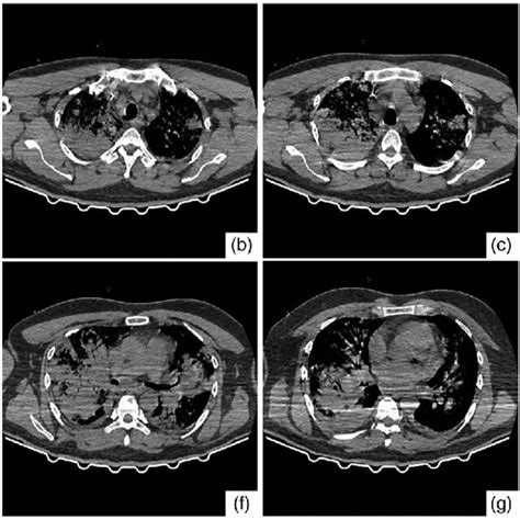 Chest Computed Tomography Findings Taken At The Time Of Download Scientific Diagram