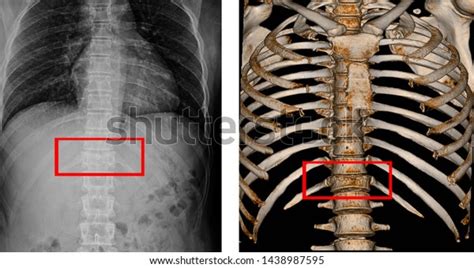 Ct Scan Thoracic Spine 3d Xray库存照片1438987595 Shutterstock