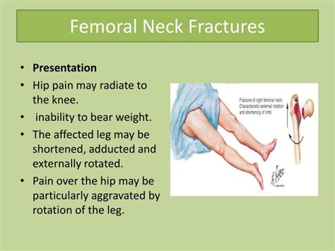 Ppt Common Lower Limb Fracture Powerpoint Presentation Id5737068