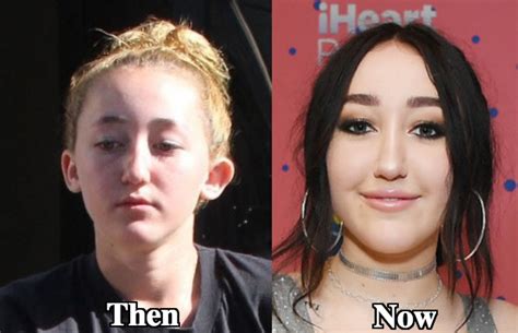 Noah Cyrus Plastic Surgery Before And After Photos Latest Plastic