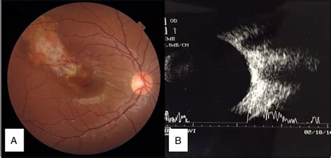 Choroidal Neovascular Membrane Diagram