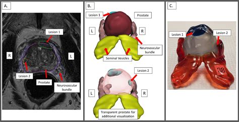 Comparison Of Multi Parametric Mri Of The Prostate To 3d Prostate