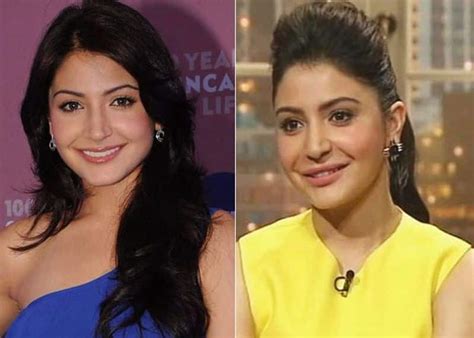 Anushka Sharma Nose Job