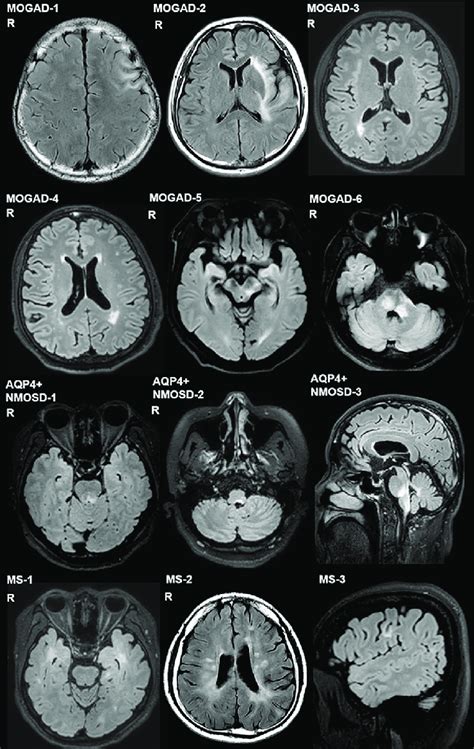 FLAIR Images Of Representative Cases Of MOGAD AQP4 NMOSD And MS