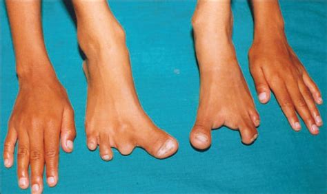 Ectrodactyly Syndrome