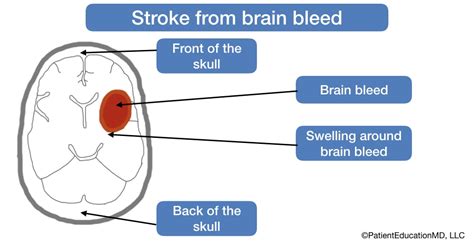 Stroke from brain bleed - PatientEducationMD