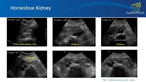 Horseshoe Kidney – NephroPOCUS